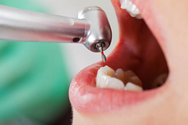 Best Knocked-Out Tooth (Avulsed Tooth) Treatment in North Windham, ME